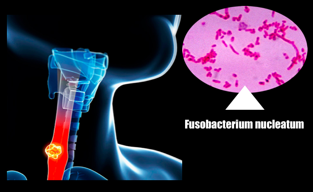 Prognóstico do cancro do esófago relacionado com bactéria oral