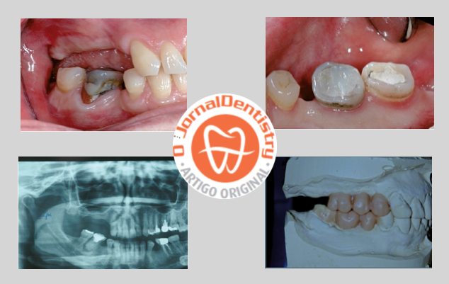 Reabilitação Oral de pacientes endêntulos posteriores com implantes. Uma estratégia Cirúrgica-Protética