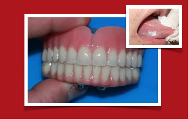 Próteses dentárias mal ajustadas podem causar cancro oral