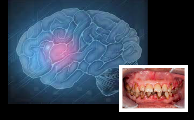 Pesquisadores descobrem  ligação entre bactérias orais, micro-hemorragias cerebrais e acidente vascular cerebral (AVC)