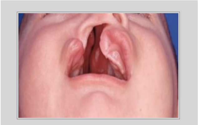 Problemas provocados pelas  fissuras labiopalatina associados às glândulas salivares