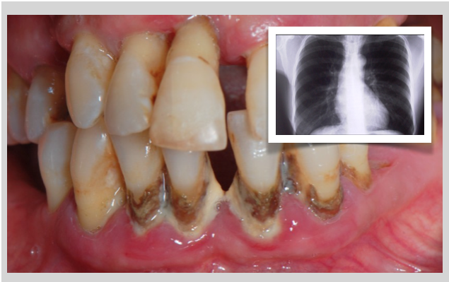 Doença periodontal pode aumentar o risco de cancro do pulmão - Estudo