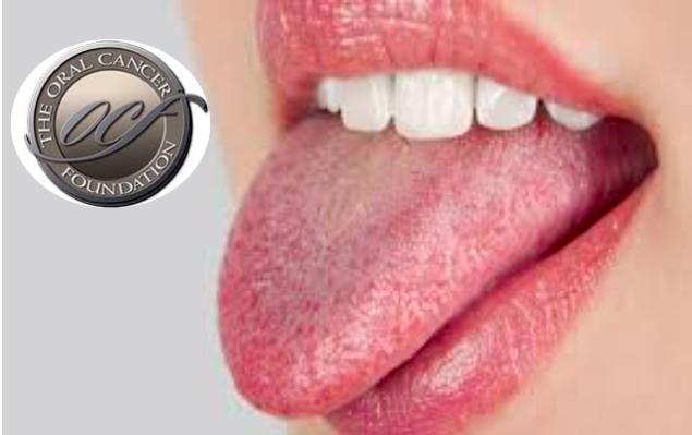 Nova formulação de elixir oral pode ajudar a aliviar os sintomas de boca seca