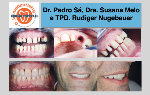 Reabilitação Oral Multidisciplinar: Tratamento Ortodôntico, Implante Dentário e Facetas em Cerâmica Feldspática