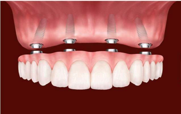 Inteligência Artificial (IA) ajuda a prever resultados do tratamento para doentes com peri-implantite