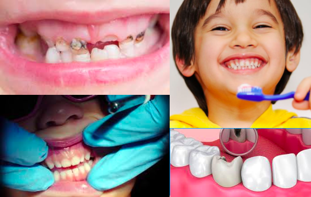 Produto químico encontrado na água potável associado à cárie dentária em crianças