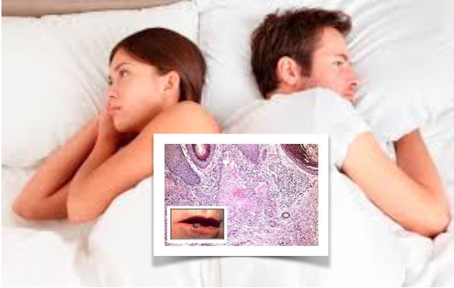 Alterações significativas no comportamento sexual após um diagnóstico de VPH positivo e cancro oral.