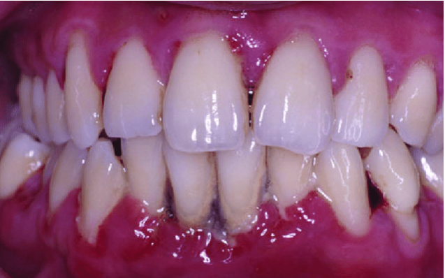 Estudo sobre futura terapia direcionada para a periodontite