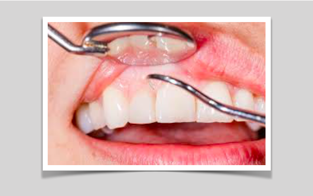 Os genes podem desempenhar um papel na cárie dentária e na periodontite