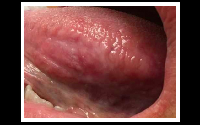 hpv virus on tongue