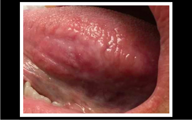 ca fesele pinworm hpv high risk genotype 16