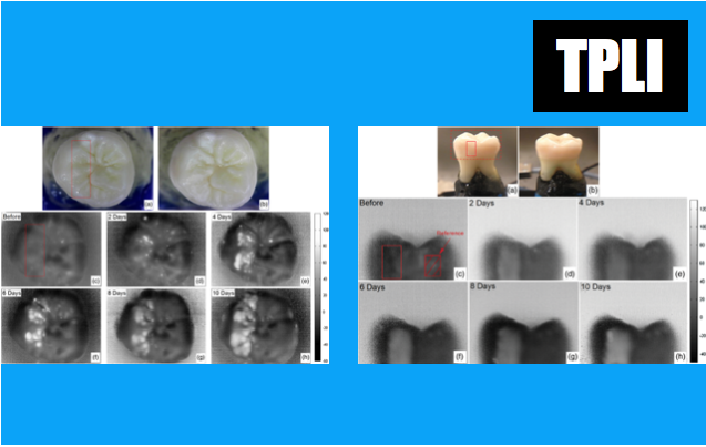 Investigação com dispositivo de imagem que poderá facilitar a deteção precoce de cáries dentárias 