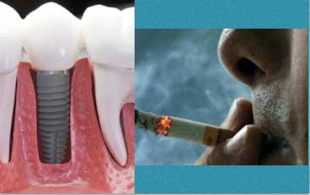 Estudo revela que fumar muito pode causar problemas com implantes dentários no maxilar inferior