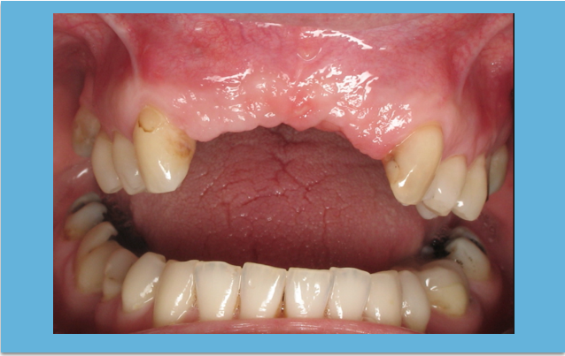 A falta de dentes deveria ser considerada uma condição médica crónica