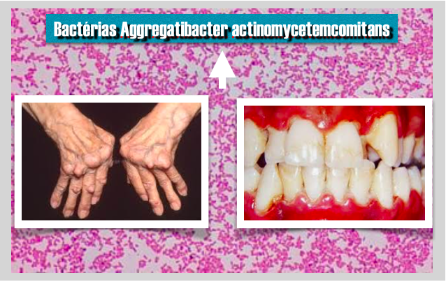 Há evidência que uma bactéria  causadora de doença gengival pode causar artrite reumatoide (AR)
