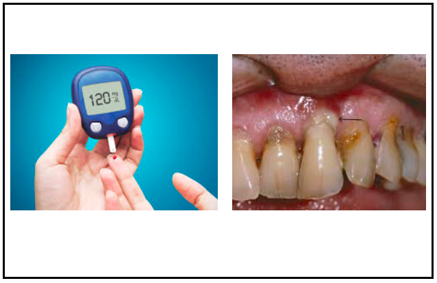 Estudo no Reino Unido sugere que uma boa saúde das gengivas pode ajudar a gerir a diabetes tipo 2