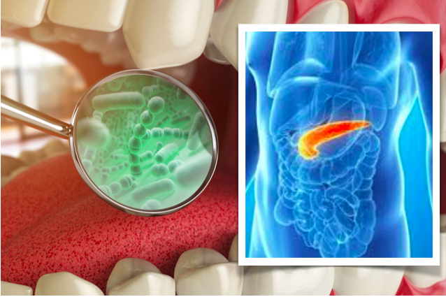 Bactérias orais no pâncreas associadas a tumores mais agressivos