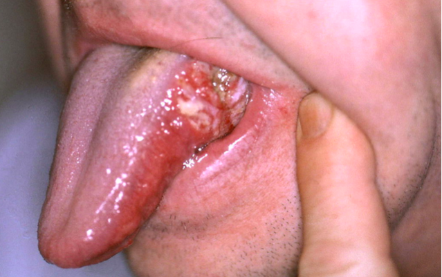 Vírus do Papiloma Humano (VPH) impulsiona aumento dos cancros orais