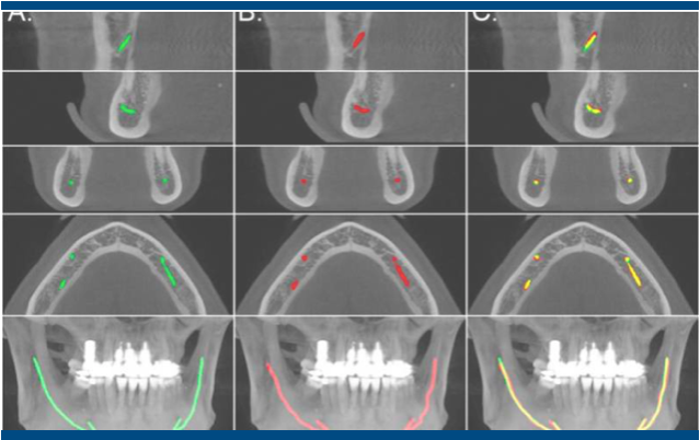 IA facilita o trabalho dos médicos dentistas: novo modelo ajuda a localizar os canais mandibulares