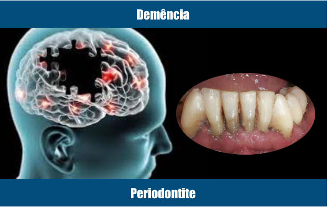 Declínio cognitivo e periodontite