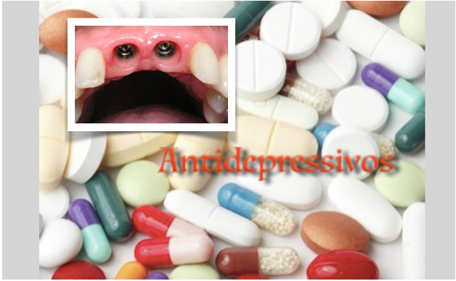 Antidepressivos podem causar falha do implante dentário