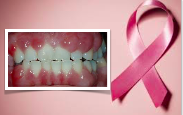 Risco de cancro de mama é até três vezes superior em mulheres com doença das gengivas