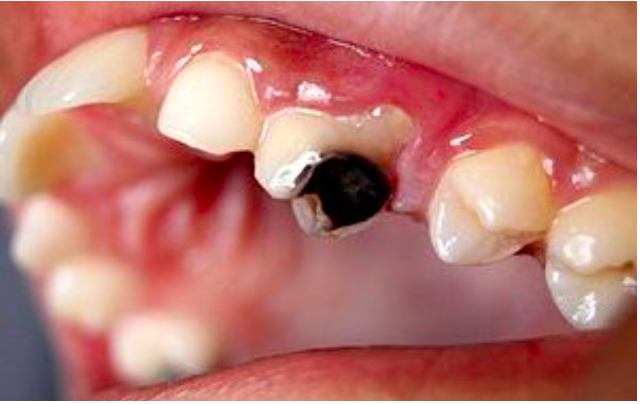 Prevenir e curar a cárie dentária com a aplicação de um peptídeo bioativo