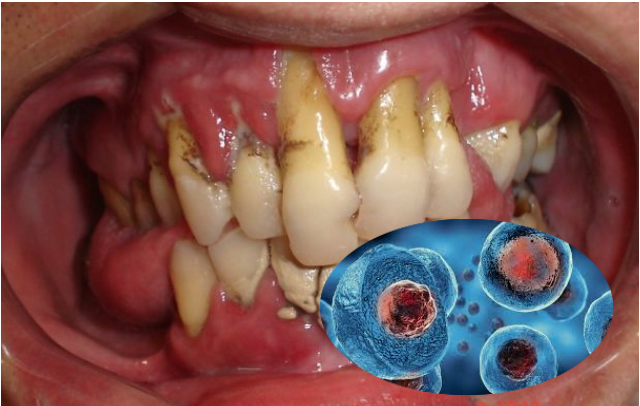 Reverter a doença periodontal com células estaminais