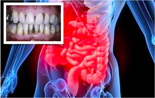 A cura da DII (doença inflamatória intestinal) pode estar na boca?