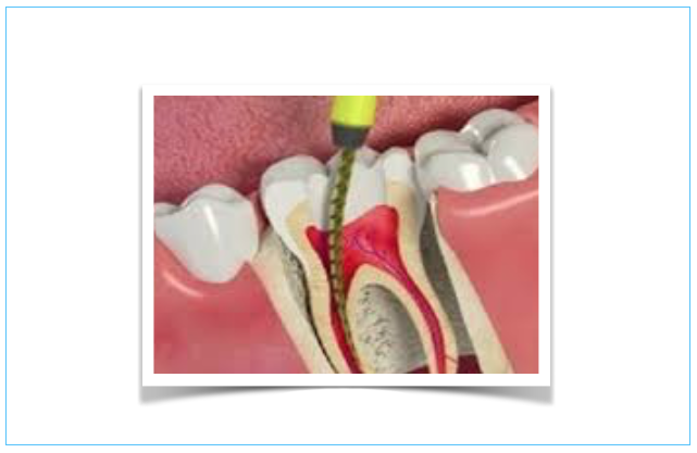 Biomaterial pode manter o dente vivo após tratamento do canal radicular