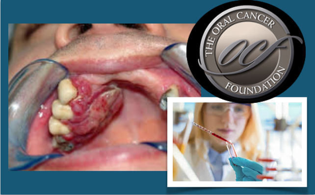 Fatos sobre o Cancro Oral —  Novos tratamentos para cancro no horizonte