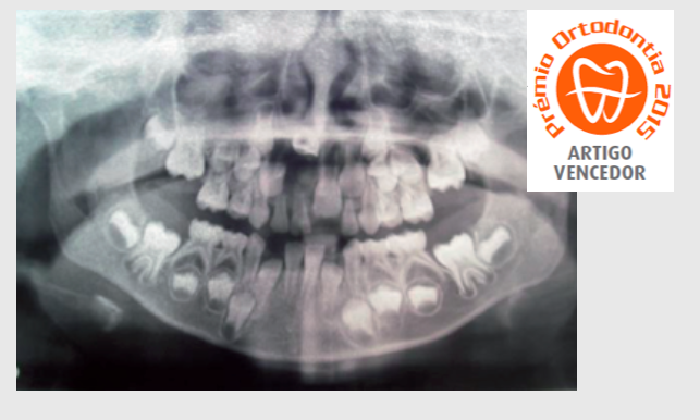 Traumatismo Dentário em Dentição Decídua um Caso Clínico de Tração Ortodôntica