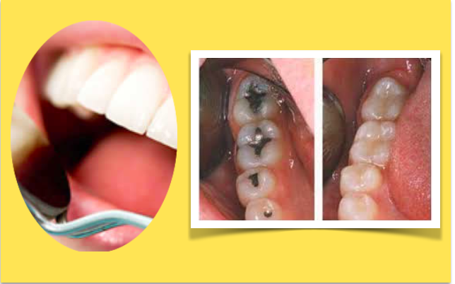 Falha do enchimento dentário  ligada ao tabagismo, bebida e genética