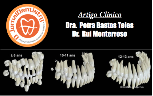 Atrasos na Erupção Dentária: Causas e Síndrome