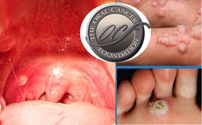 virus del papiloma tratamiento y prevencion hpv imiquimod cream