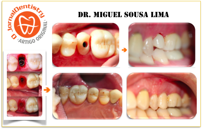 Caso Clínico: A previsibilidade na construção da anatomia rosa no período de osteointegração.