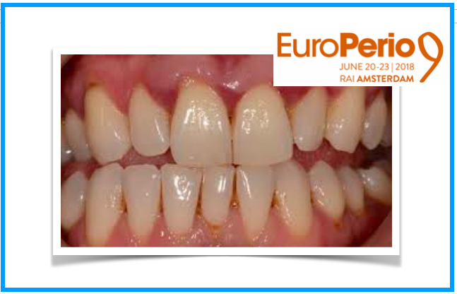 A doença Periodontal e doença Arterial Coronariana partilham base genética