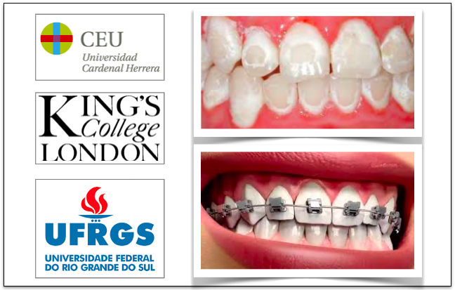 Materiais adesivos desenvolvidos para evitar as manchas nos dentes  provocadas pelos brackets