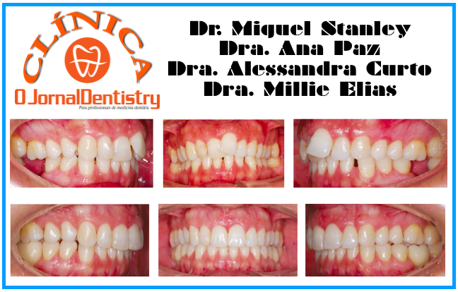 Quanto custa o tratamento com Invisalign?