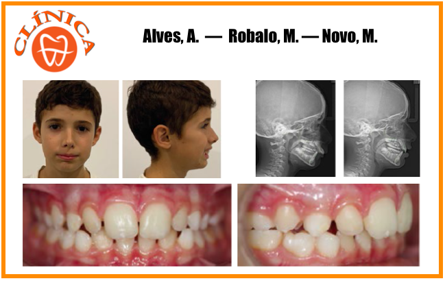 Ortodontia Interceptiva na consulta de Odontopediatria - Caso Clínico