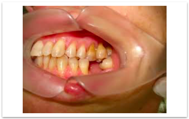 Perda dentária na meia idade e o  risco de doença coronária