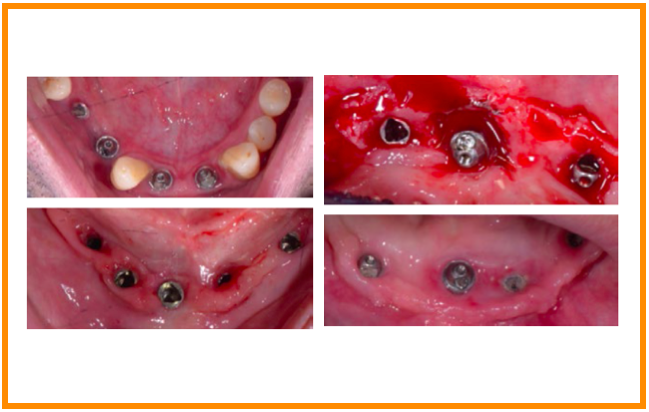 Mucosite vs. Peri-Implantite