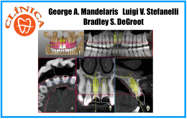 Navegação Dinâmica para colocação cirúrgica de implantes: Visão geral da tecnologia, conceitos e relato de um caso clínico