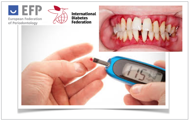Workshop realizado pela EFP e IDF sobre as ligações entre doenças periodontais e diabetes produz consenso e diretrizes