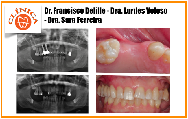 Utilização de Matriz de Cologénio GEISTLICH FIBROGIDE® para regeneração tecidular