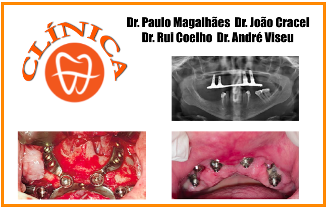 Reabilitação de maxilar superior atrófico com recurso a implantes Zigomáticos previamente colocados combinados com um implante individualizado - Caso Clínico