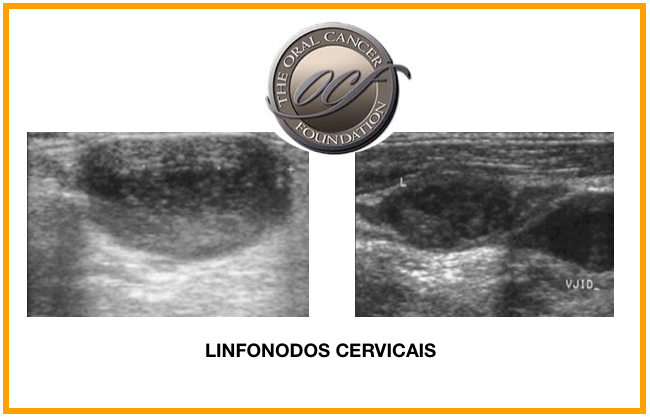 Identificada a assinatura prognóstica de cancro oral