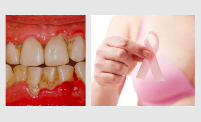 Doença periodontal associada ao   risco de cancro de mama em mulheres na menopausa