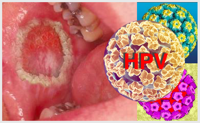 Infeções por HPV causam cerca de 80% dos cancros orofaríngicos nos Estados Unidos. (Ref. National Cancer Institute)