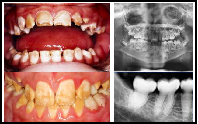 A ligação anormal de proteínas impede a criação da estrutura do esmalte, o que pode levar a dentes com problemas